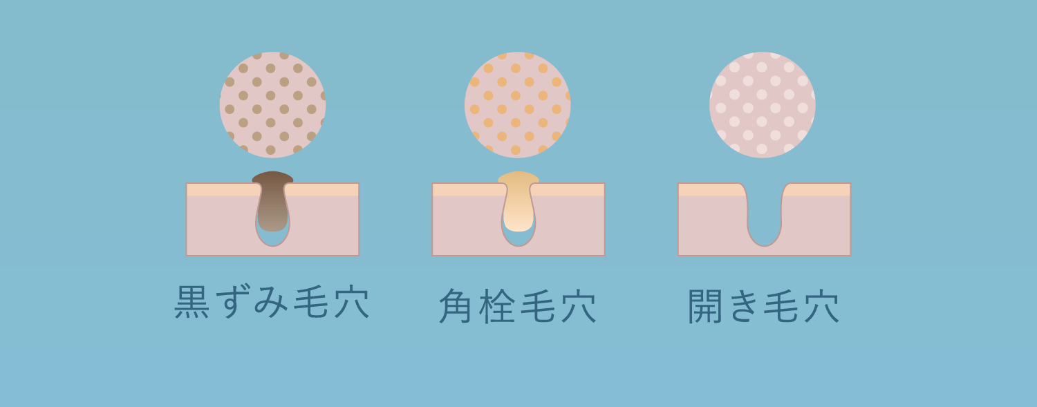 黒ずみ毛穴、角栓毛穴、開き毛穴